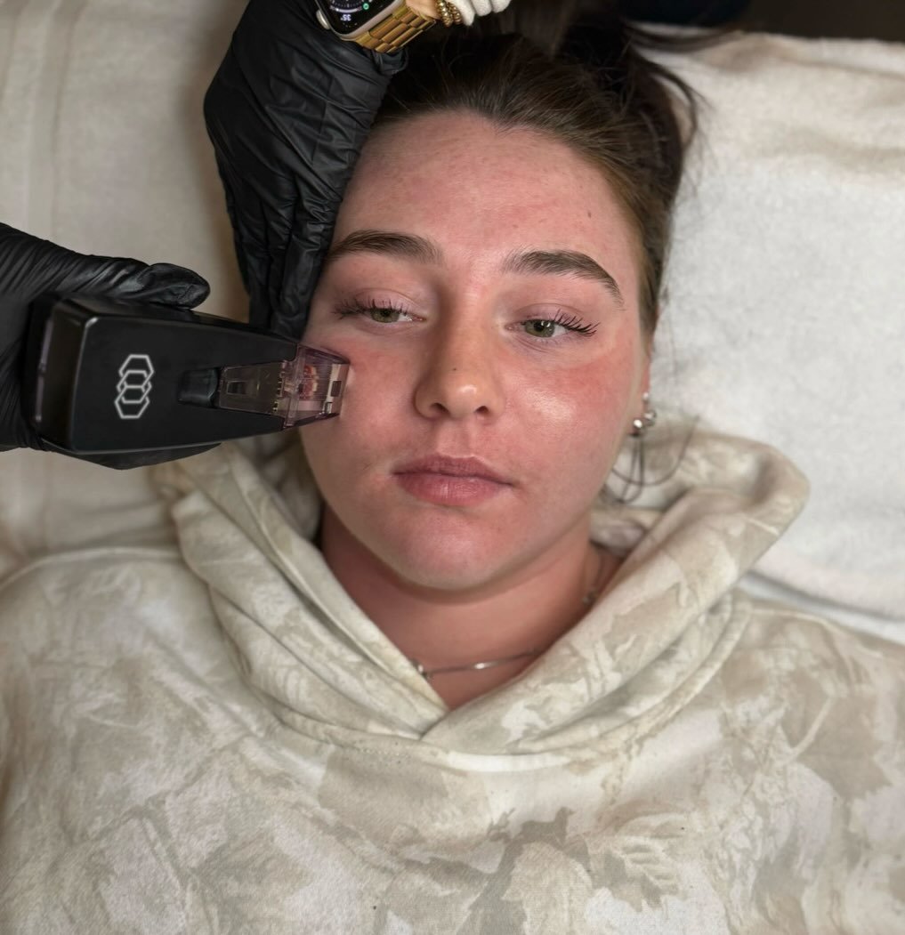 Not sure what Microneedling/ Morpheus is for? Have no fear! 

Morpheus8 is designed to address a wide range of skin and body concerns, including:

-Skin laxity and loss of firmness
-Fine lines and wrinkles
-Uneven tone and texture
-Reduced collagen p