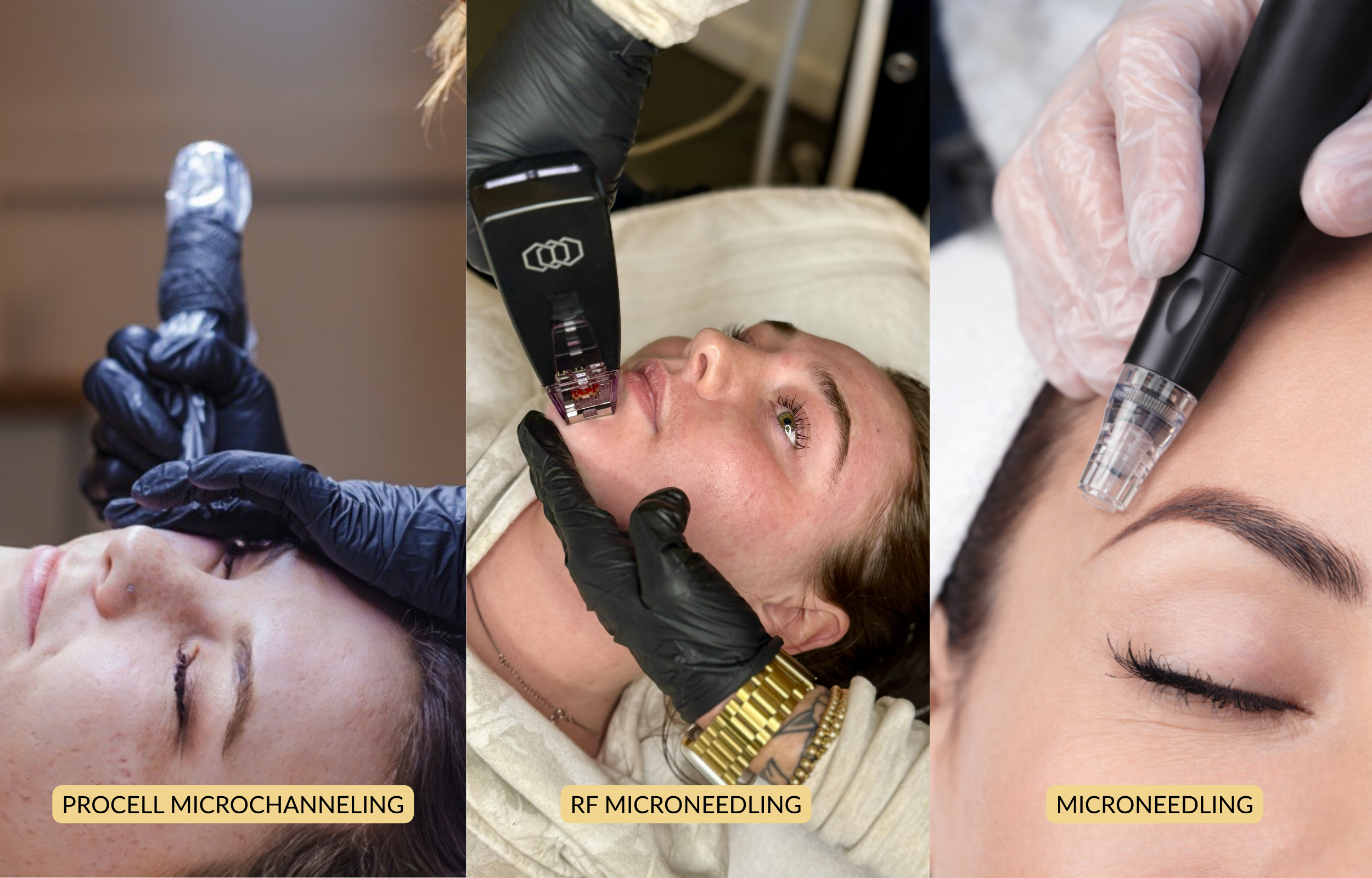 The Difference Between Microneedling, Procell Microchanneling, and RF Microneedling