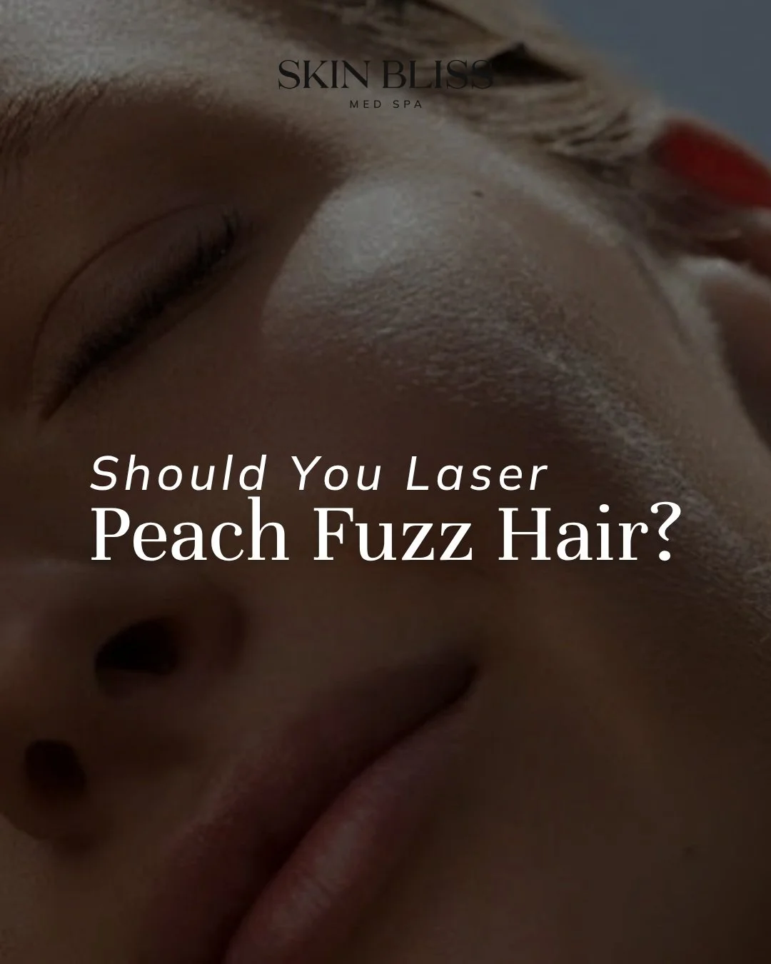 Ever notice that fine peach fuzz on your face when the light hits just right? You're definitely not the only one wondering if laser is the answer.

When it comes to facial hair, especially fine vellus hair, laser isn't always the best option. The typ