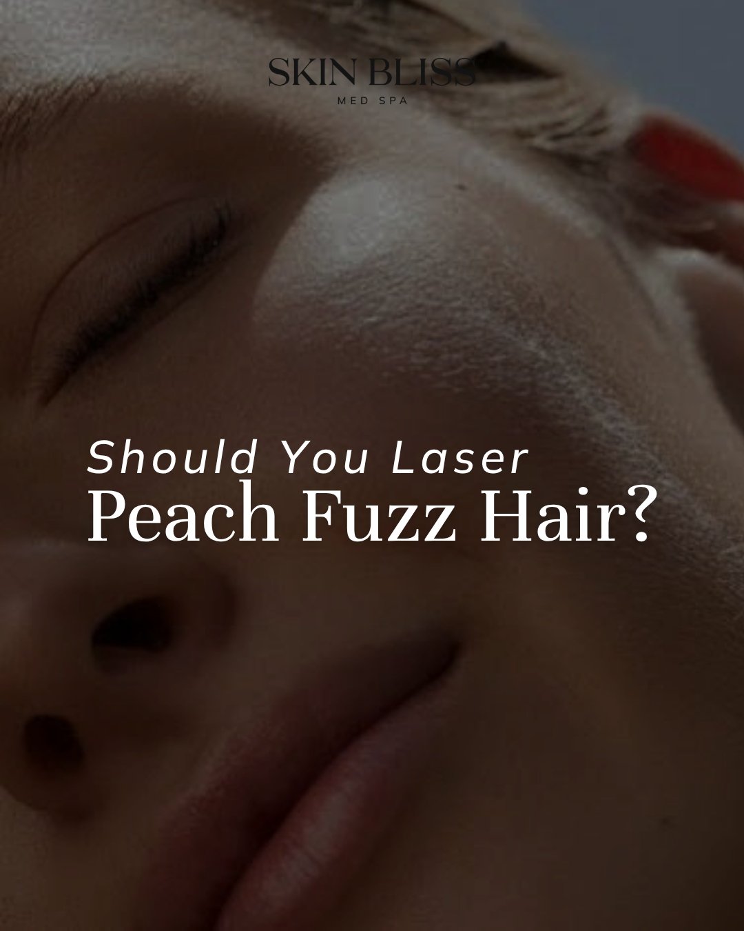 Ever notice that fine peach fuzz on your face when the light hits just right? You're definitely not the only one wondering if laser is the answer.

When it comes to facial hair, especially fine vellus hair, laser isn't always the best option. The typ