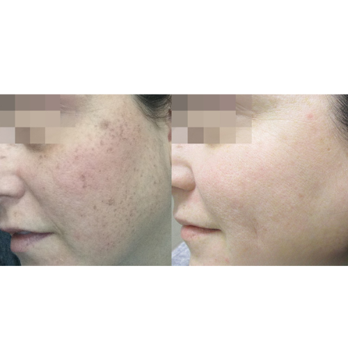 Lumecca IPL Facial Before and After Result