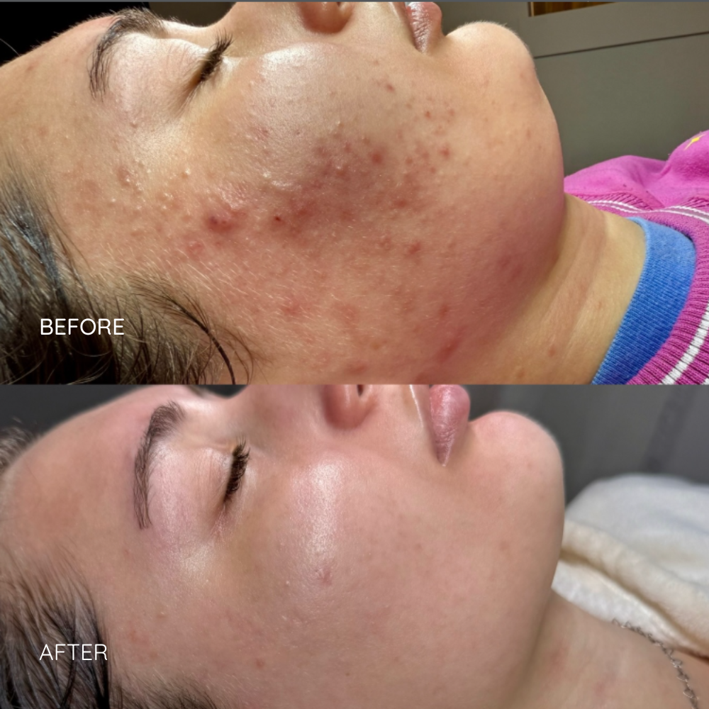 Before and After Acne Treatment