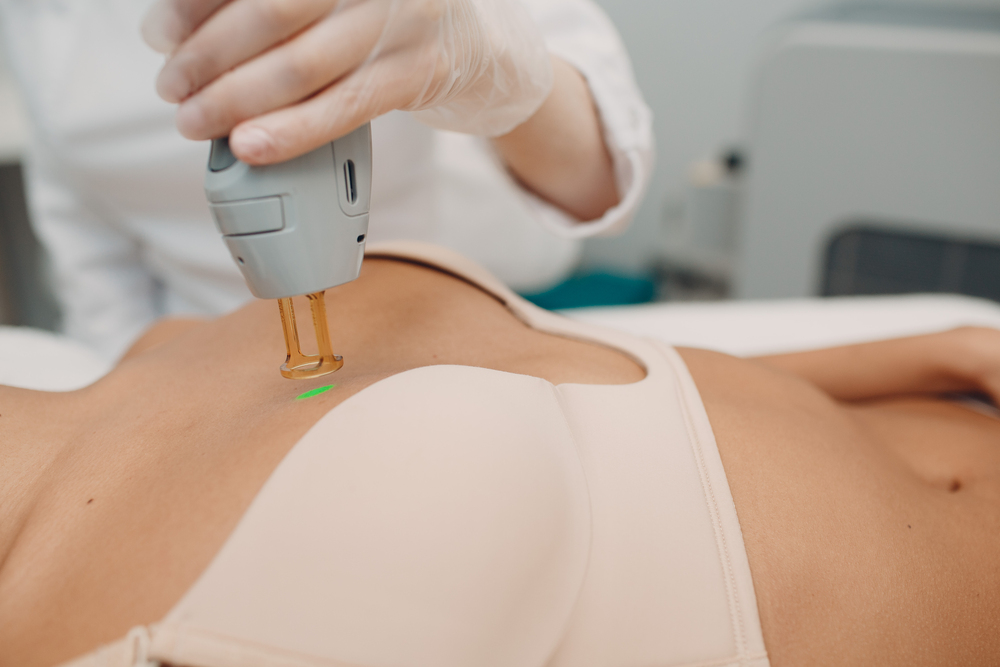 Areola Laser Hair Removal