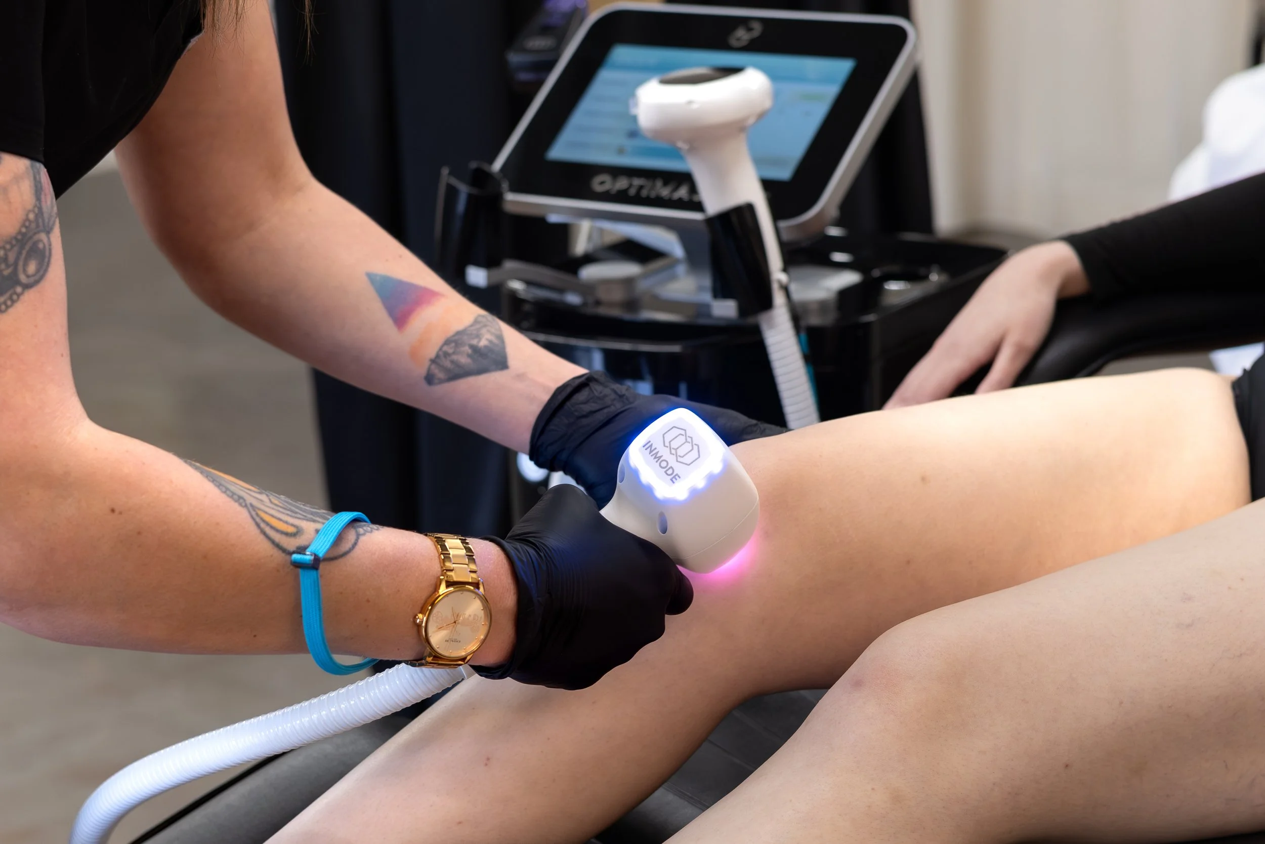 Laser Hair Removal for Legs