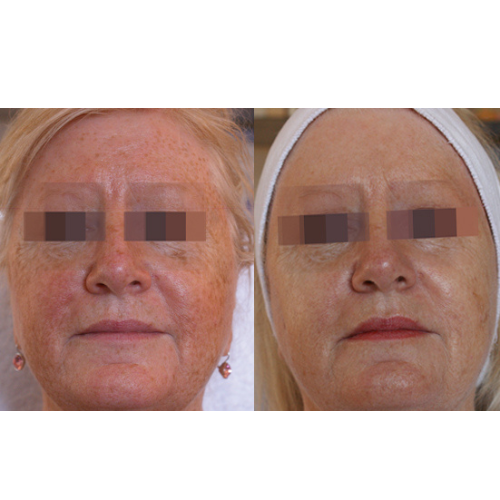 Lumecca IPL Facial Before and After Result