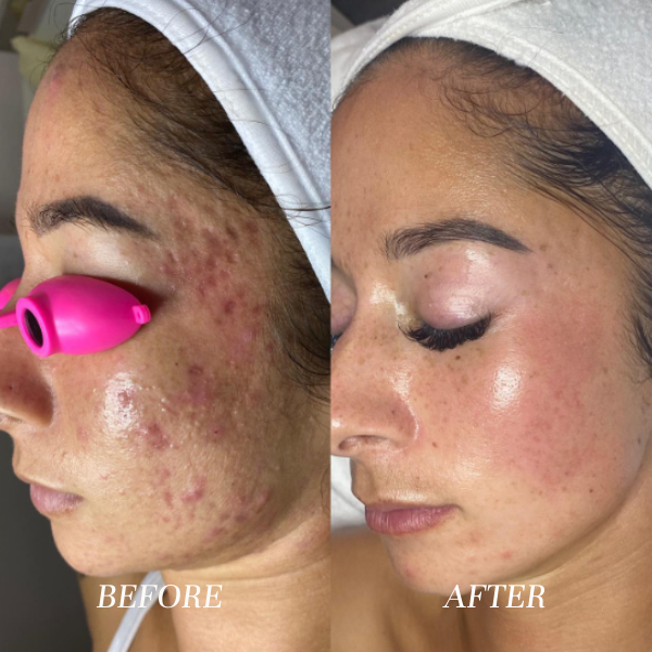 Acne Marks