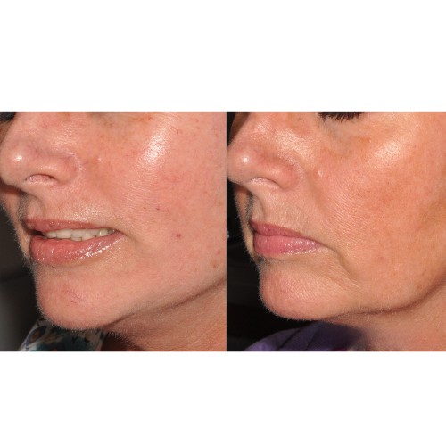 Lumecca IPL Facial Before and After Result