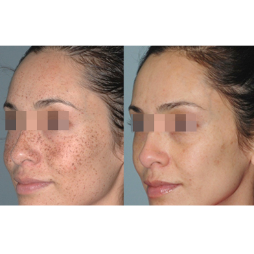 Lumecca IPL Facial Before and After Result