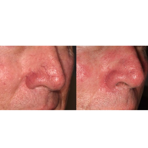 Lumecca IPL Facial Before and After Result