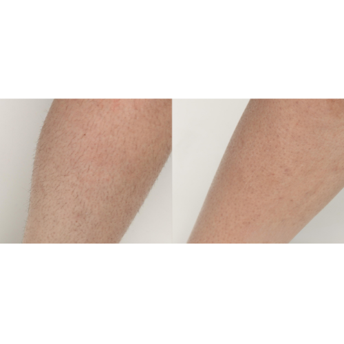 Diolaze Laser Hair Reduction Before and After Result Leg