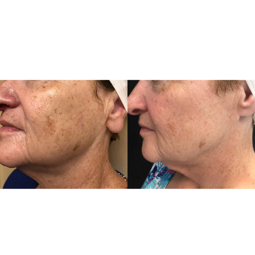 Lumecca IPL Facial Before and After Result