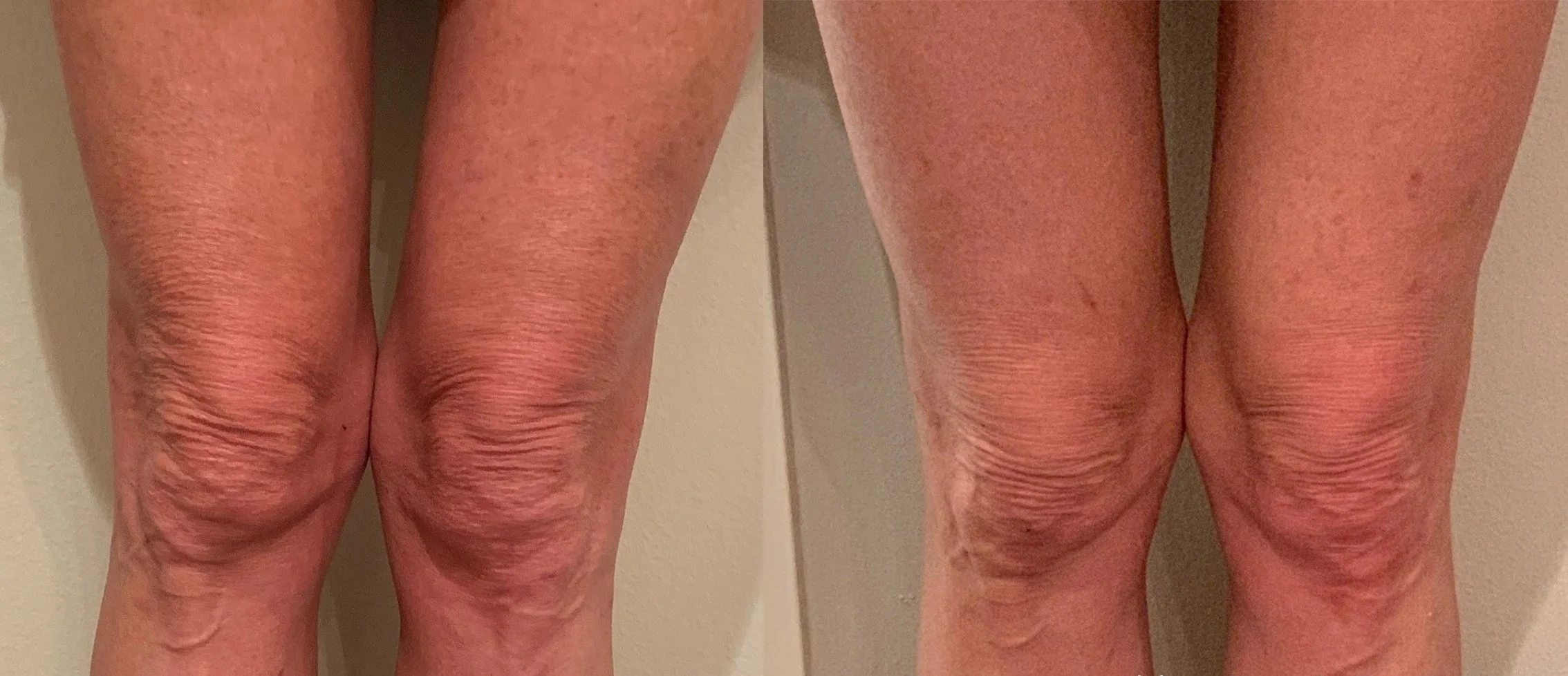 Morpheus8 RF Microneedling Before and After Result