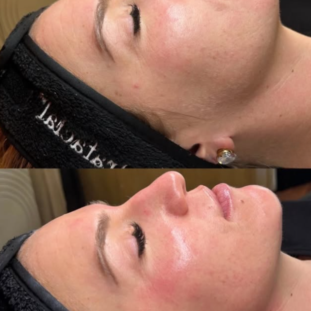 Glass Skin Facial Before and After
