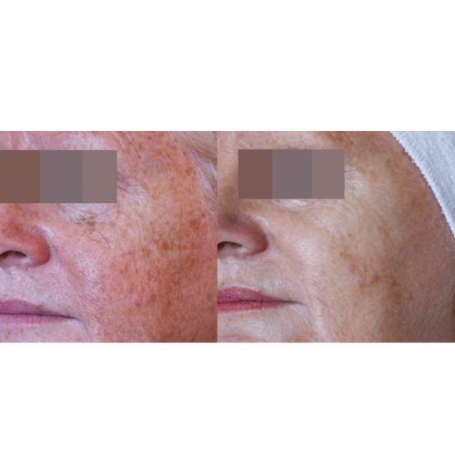 Lumecca IPL Facial Before and After Result