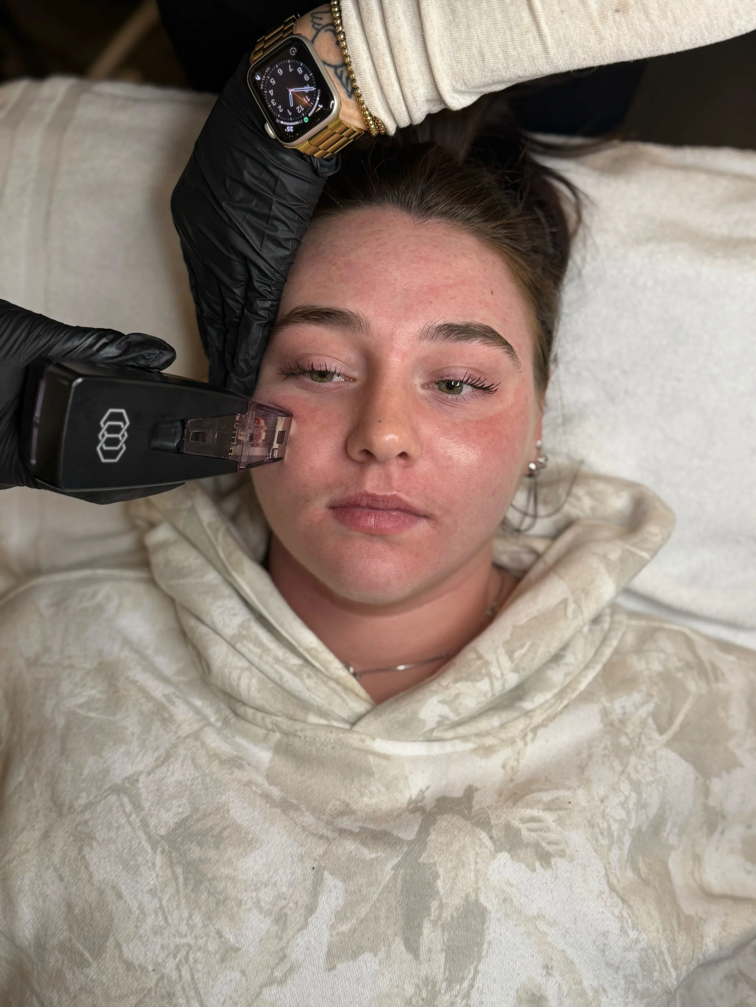 A woman lying on a medical bed with her head supported, receiving a cosmetic treatment on her cheek from a practitioner wearing black gloves. The woman has light skin, green eyes, and is wearing a beige hoodie with a tie-dye pattern, and a beaded bracelet.