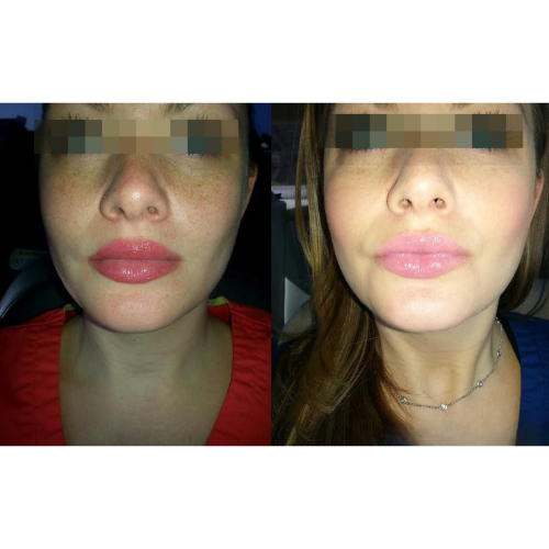Lumecca IPL Facial Before and After Result