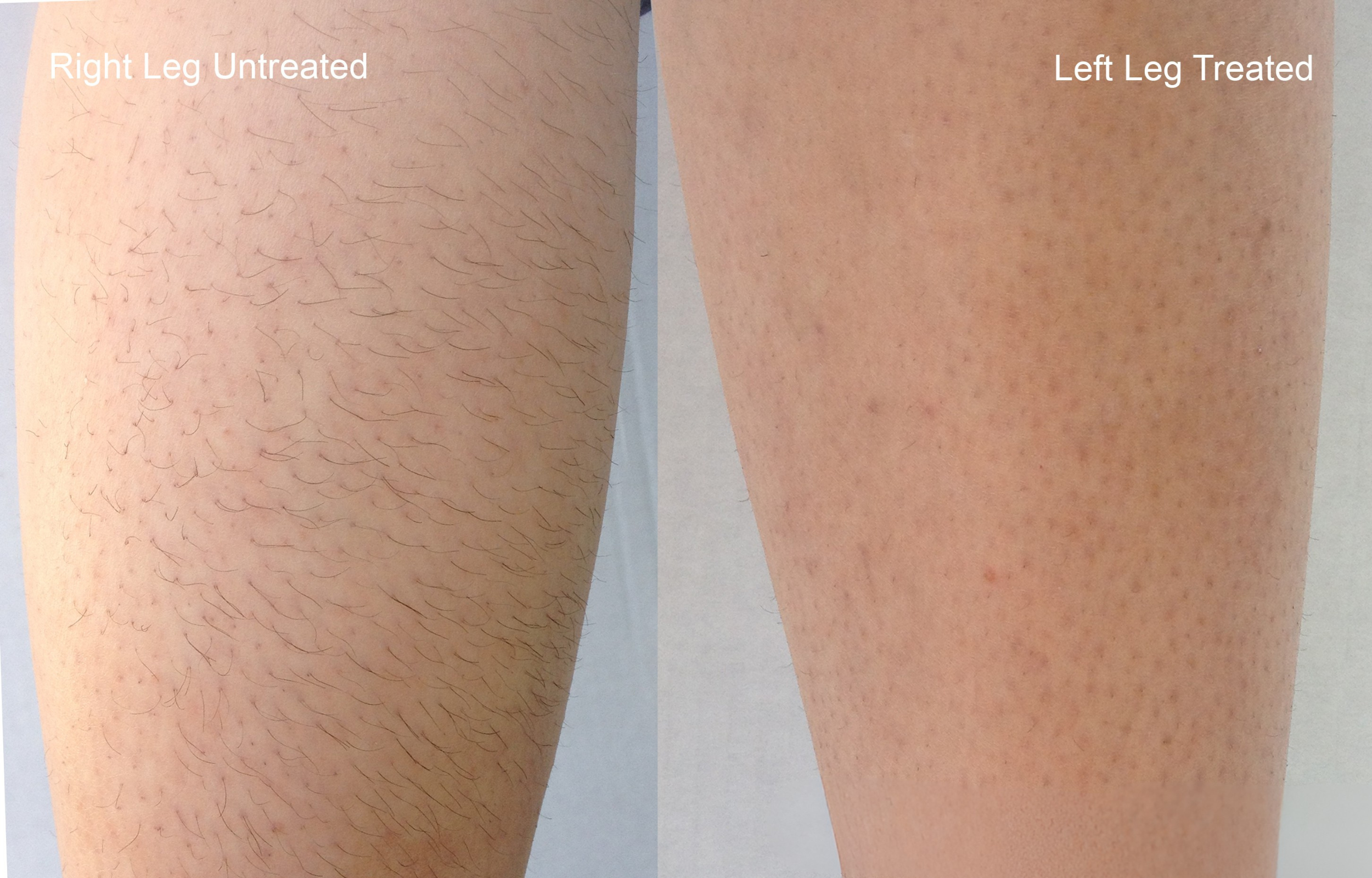 Laser Hair Removal