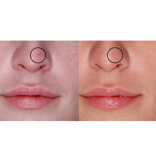 Lumecca IPL Facial Before and After Result