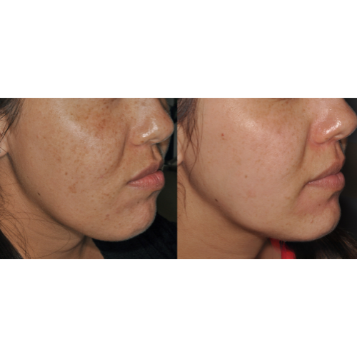 Lumecca IPL Facial Before and After Result