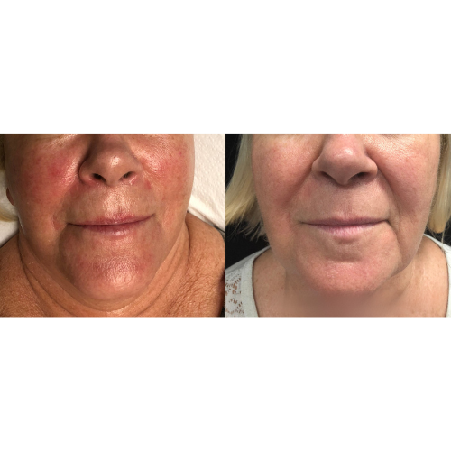 Lumecca IPL Facial Before and After Result