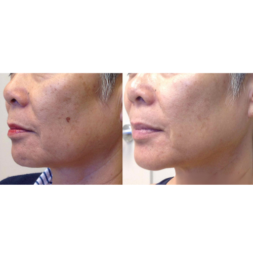 Lumecca IPL Facial Before and After Result
