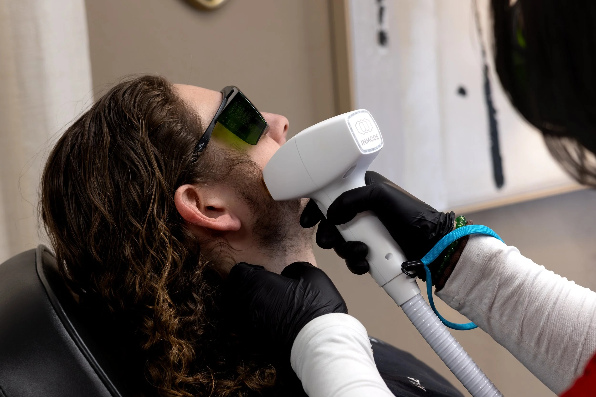 Laser hair removal for men's beard