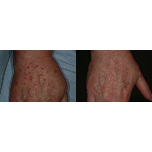 Lumecca IPL Facial Before and After Result