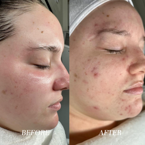 Acne Marks