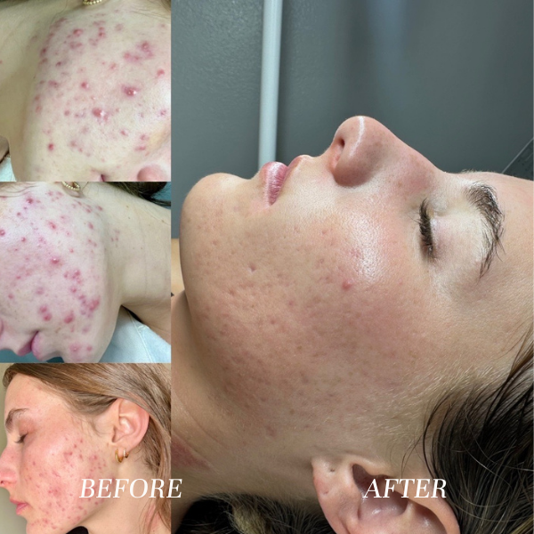 Acne Marks