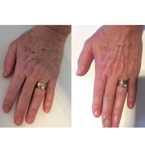 Lumecca IPL Facial Before and After Result