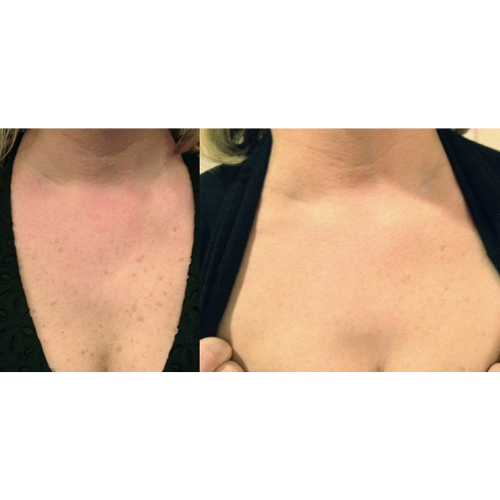 Lumecca IPL Facial Before and After Result