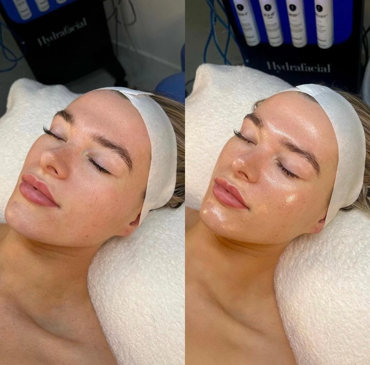 Hydrafacial Before and After Result