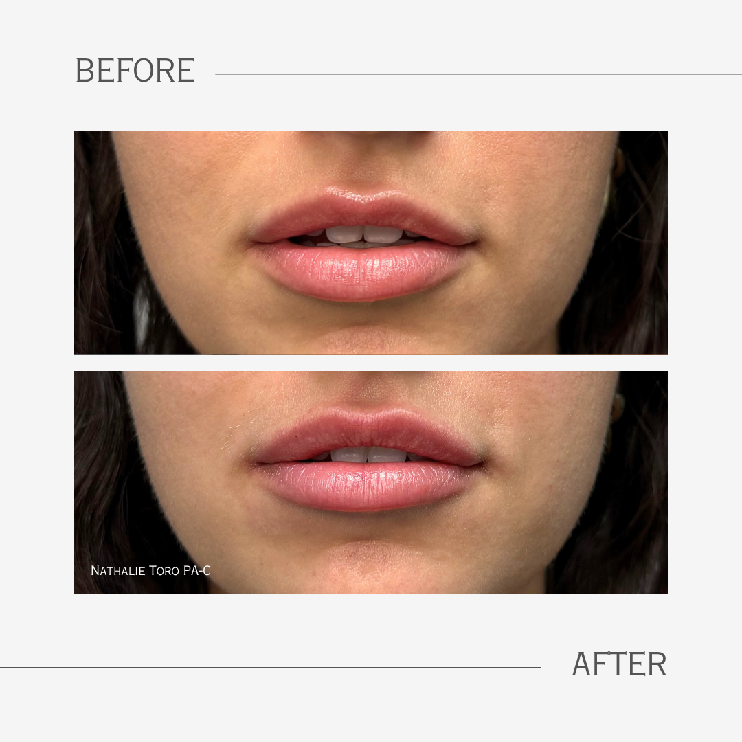 Close-up of a woman's lips before and after lip augmentation, showing fuller more symmetrical lips in the after image.