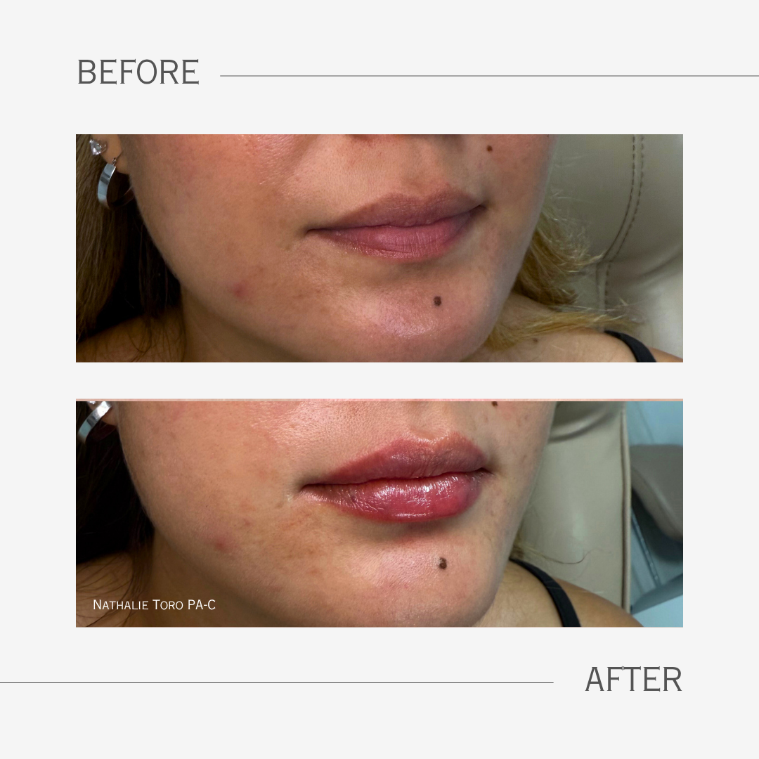 Comparison of a woman lips before and after a lip filler procedure, showing smoother skin and fuller lips in the after photo.