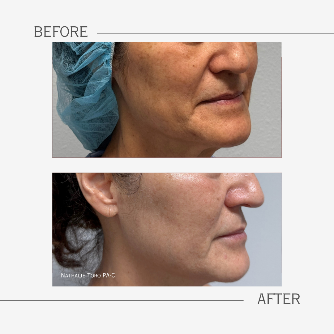 Comparison of a woman's face before and after a CO2 fractional laser procedure showing improved skin texture and tone, with the 'before' image featuring acne scars and uneven skin and the 'after' image showing smoother skin.
