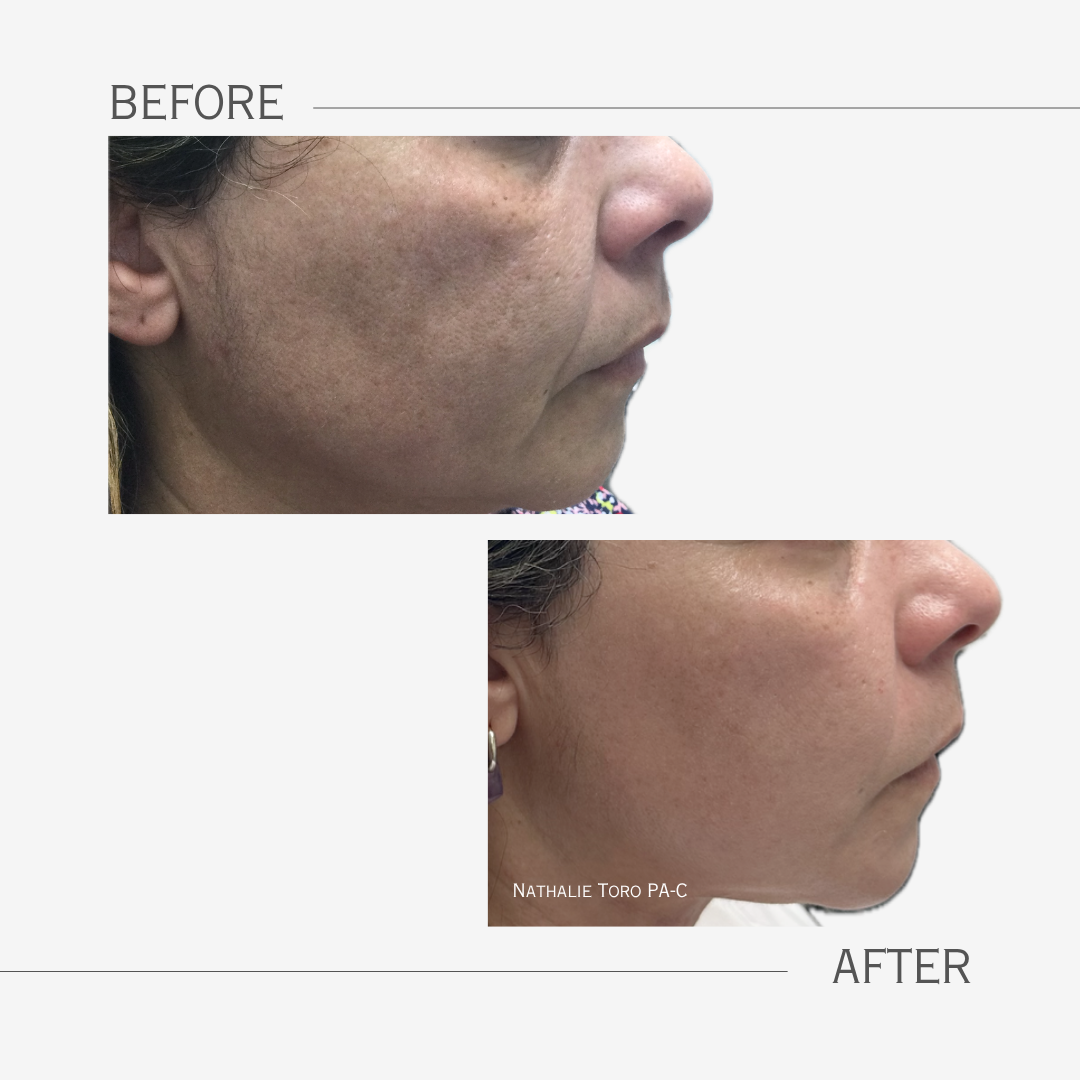 Comparison of skin before and after CO2 fractional laser treatment, showing reduced hyperpigmentation, smoother skin texture, and improved skin tone on a woman's face.