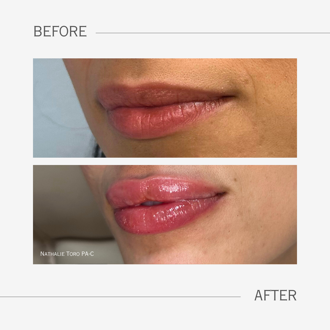 Lip Filler