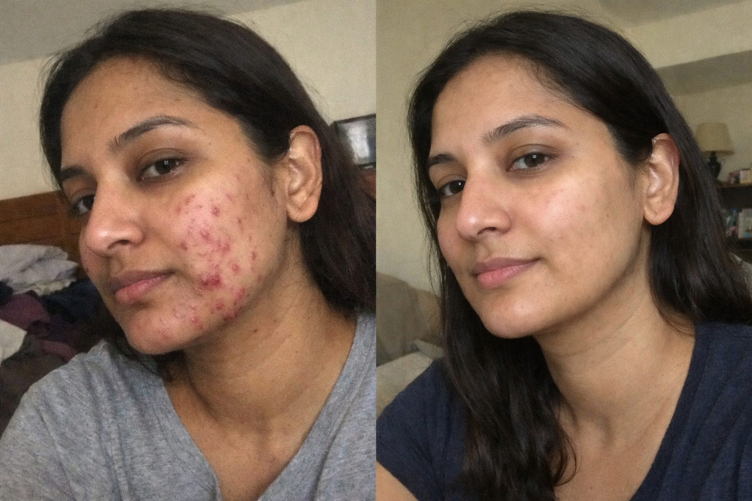 Before and after clear skin