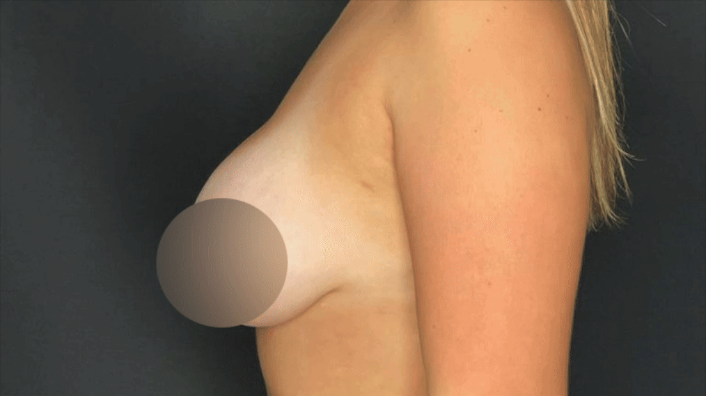 Side view of a woman's partially nude torso with a blurred circle over her breast, against a dark background.