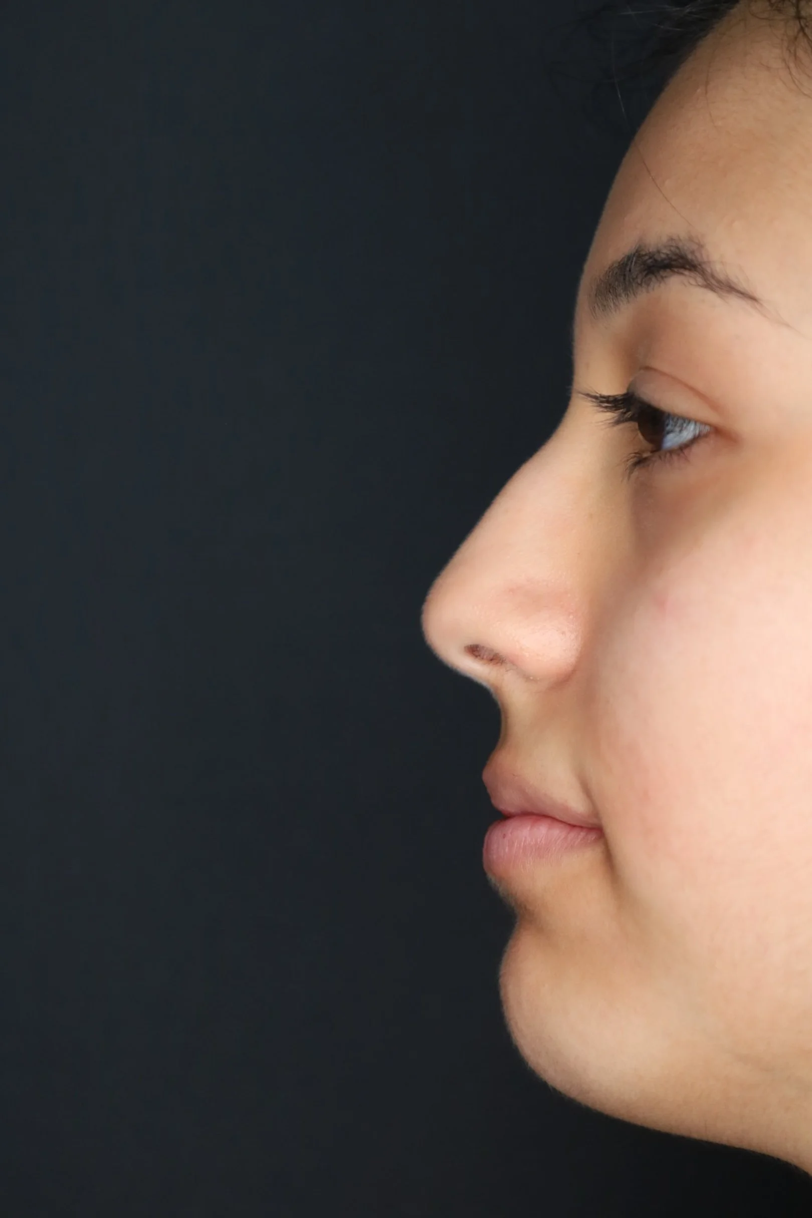 HYULIA RINOPLASTIA(1).JPG