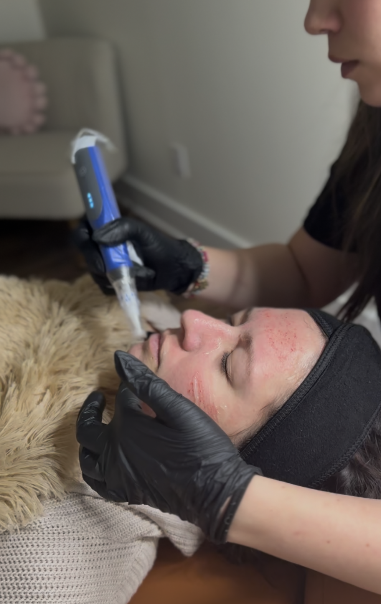 Everything Nurse Practitioners Want You to Know About Microneedling