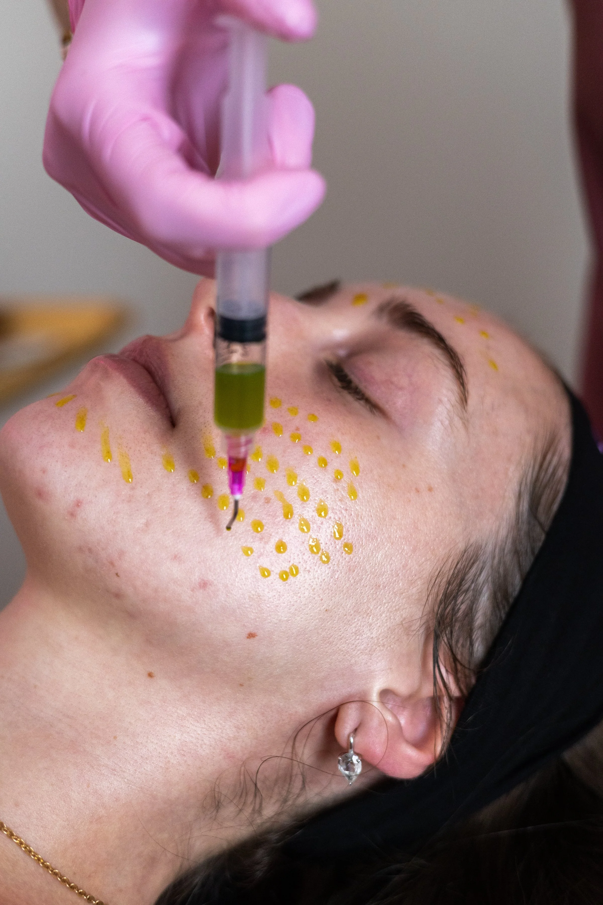 The Most Popular Chemical Peels in Albany County, New York