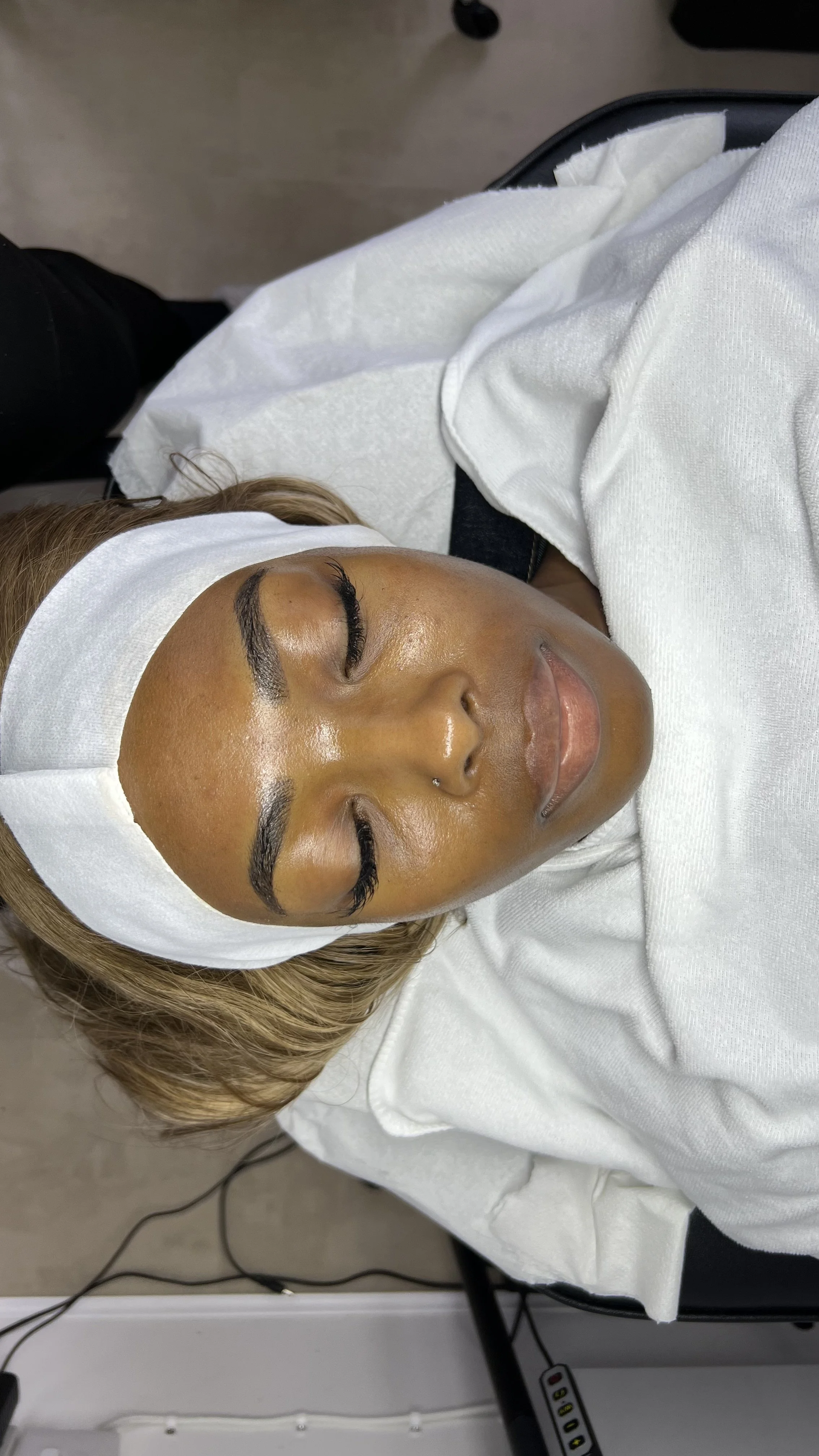 Mesotherapy Microneedling 