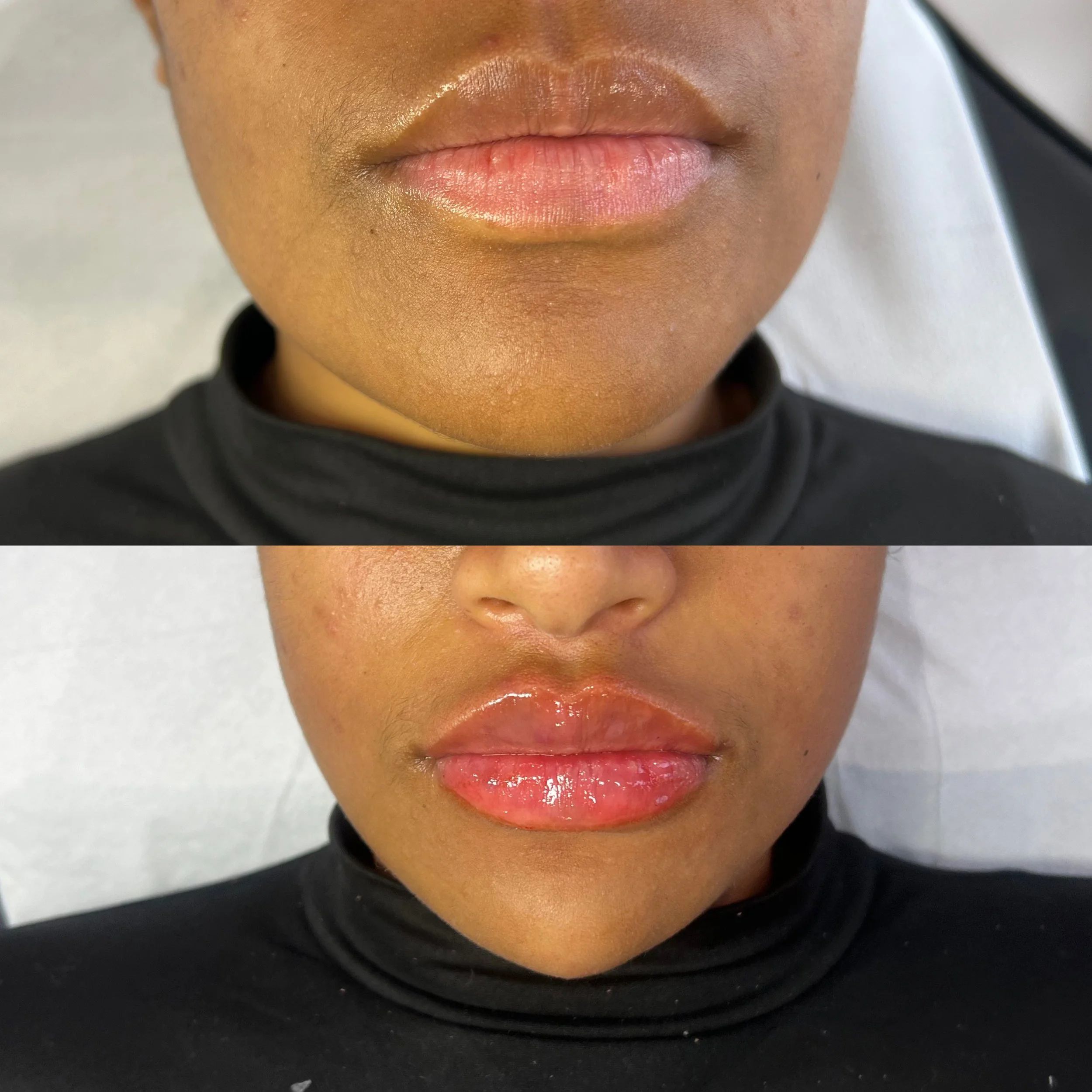 Chin & lip combo