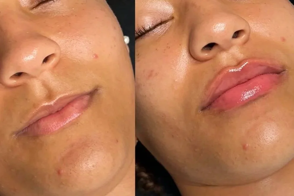 0.5ml Lip Filler