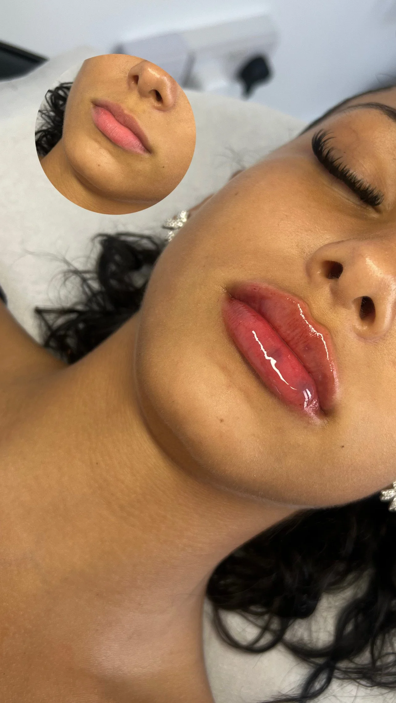 0.7ml M shape lip filler