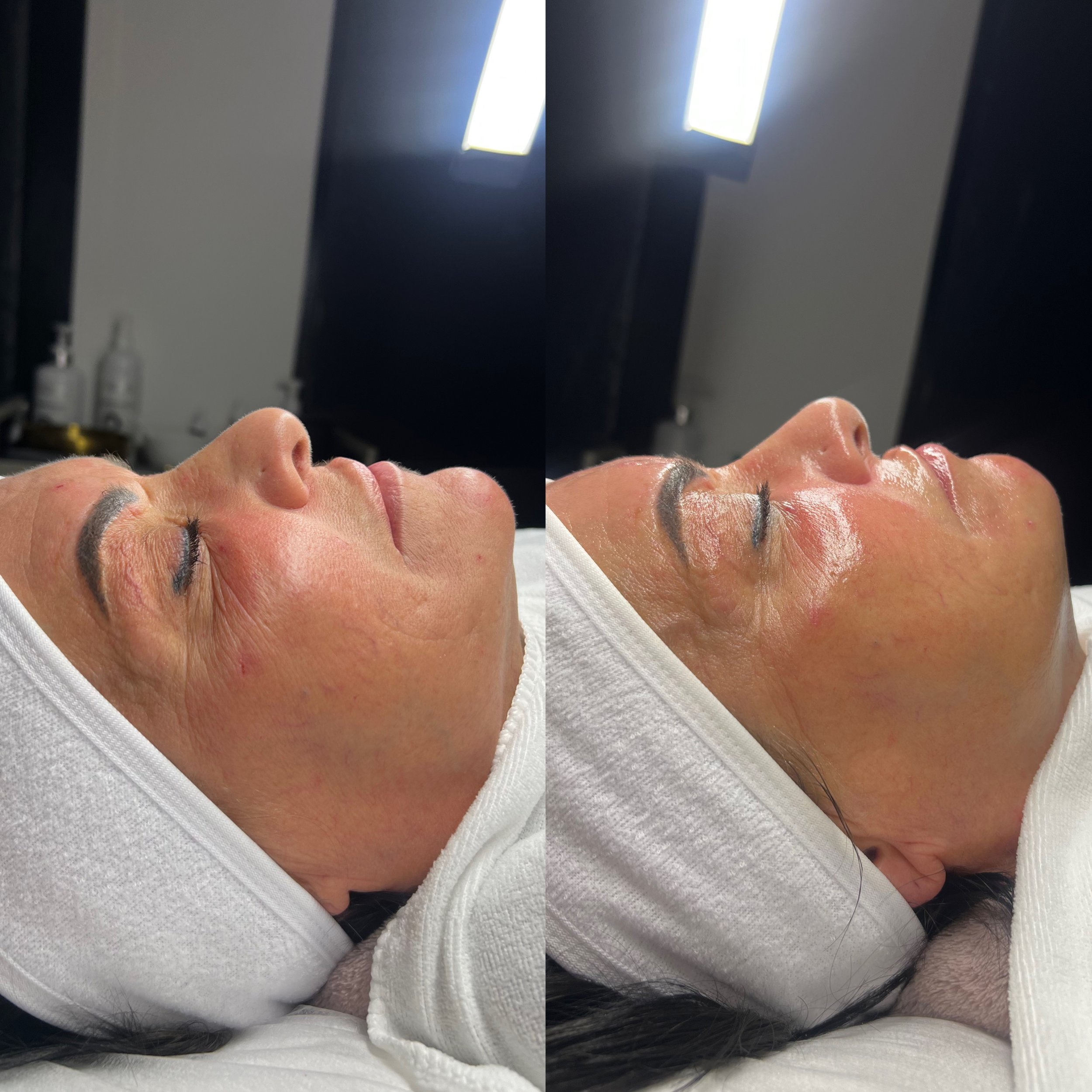 Korean Glass Lift Facial