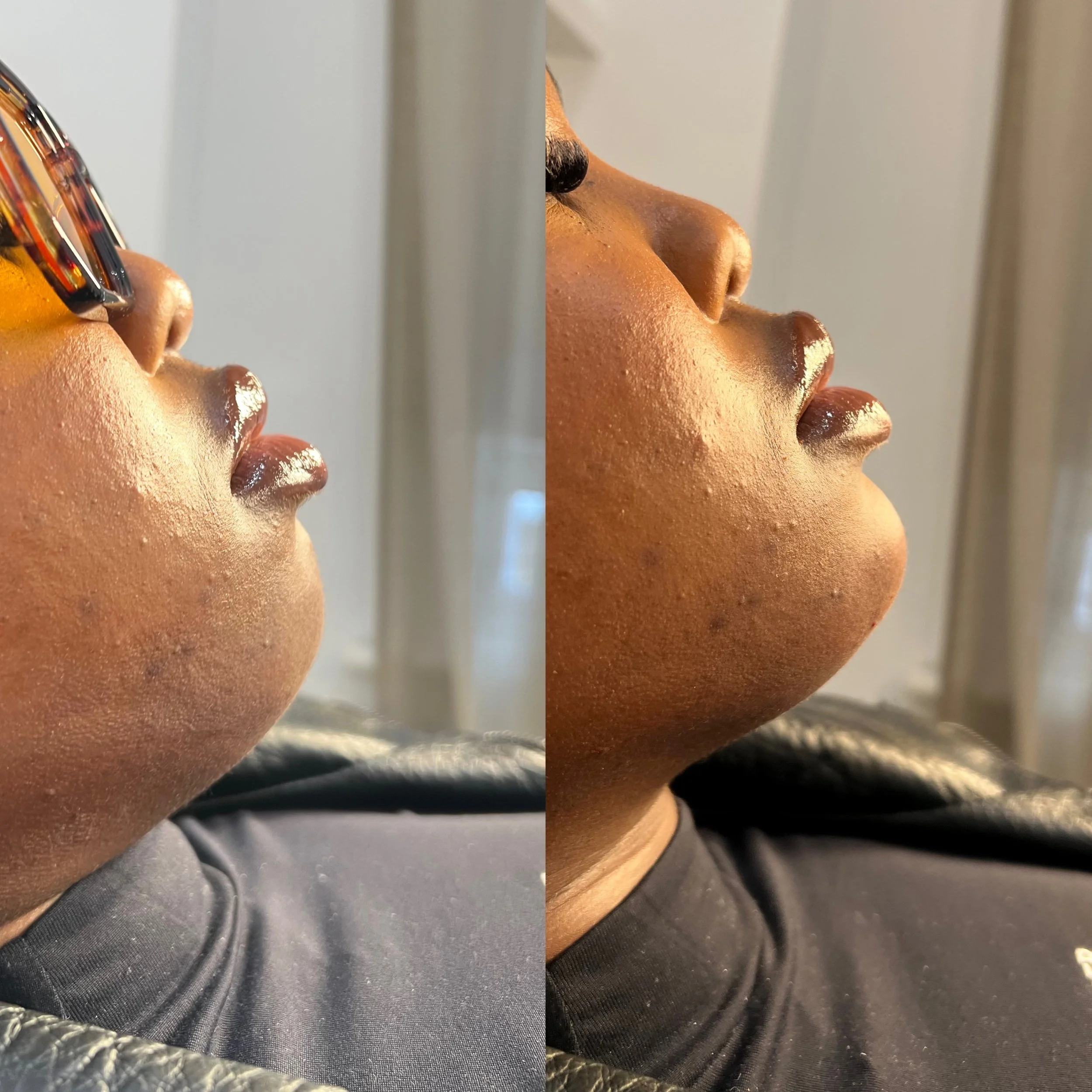 1ml Chin Filler 