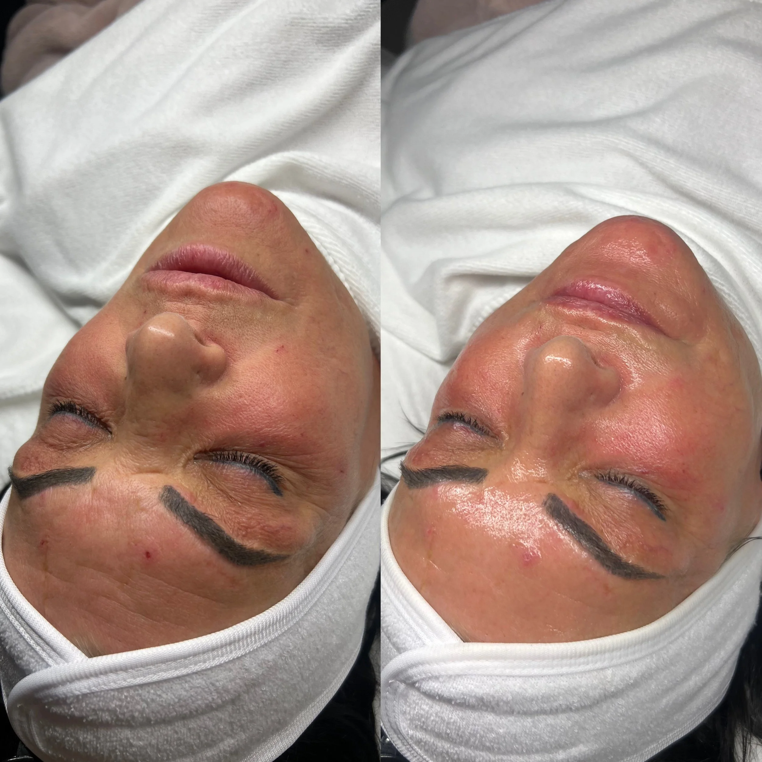 Korean Glass Lift Facial