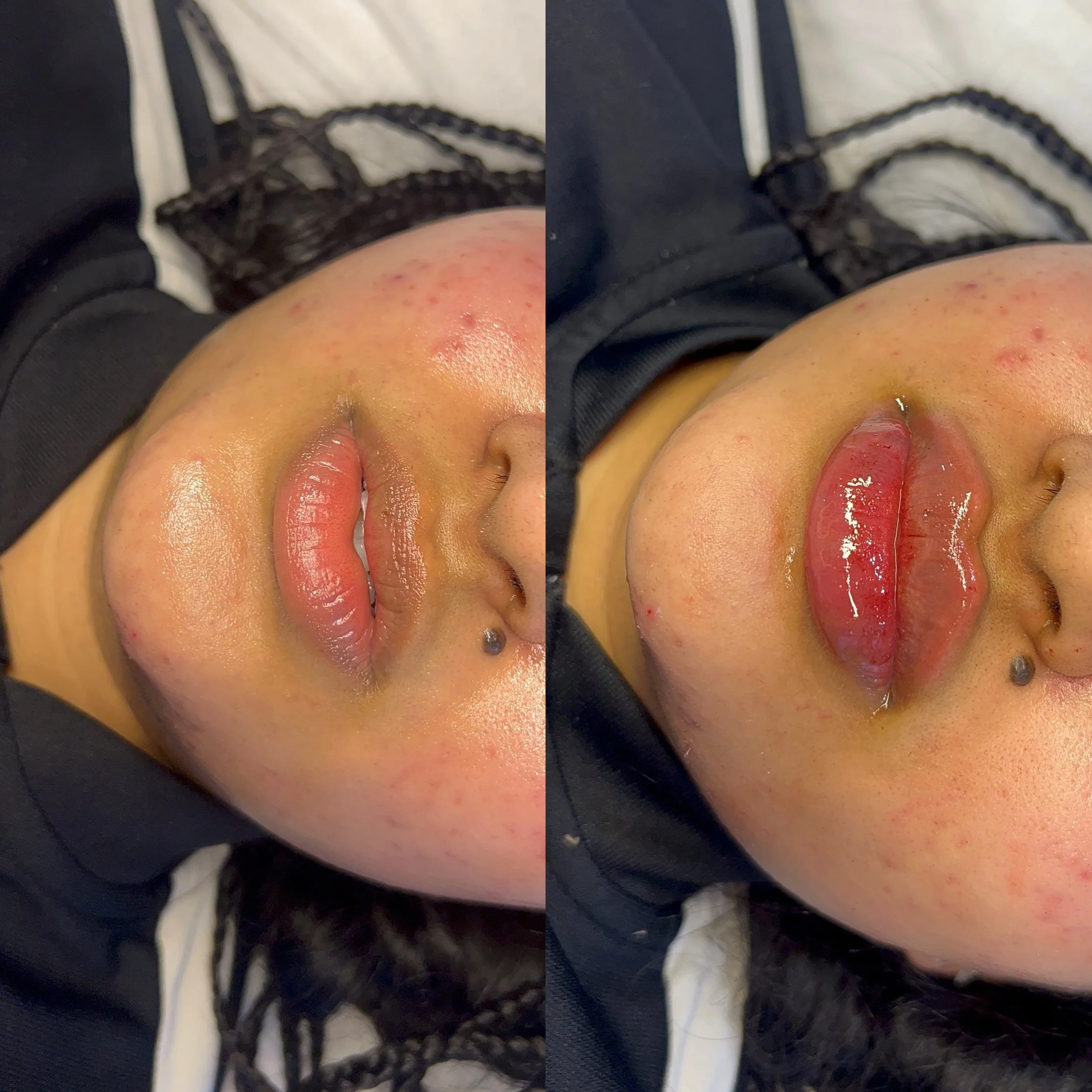 1ml Lip Filler